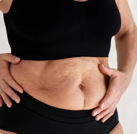 Complete Guide to Mommy Makeover Procedure