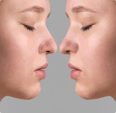 Ultimate Guide to Rhinoplasty