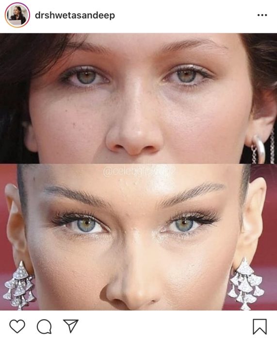 Eyebrow lift with Botox