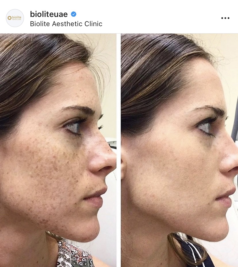 DermaSweep Exfoliation Treatment