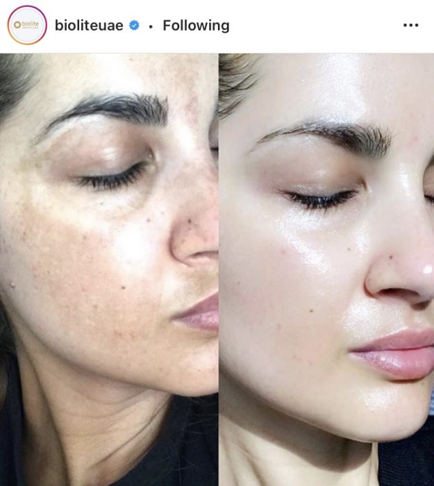 Result of SilkPeel Dermalinfusion