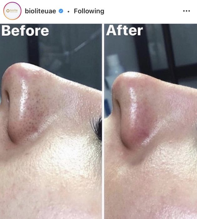 Result of SilkPeel Dermalinfusion