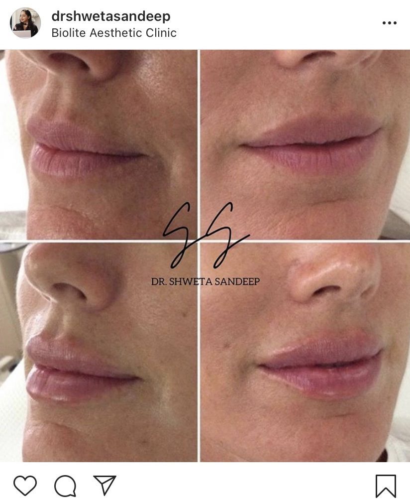 Lip treatments for a lifted face