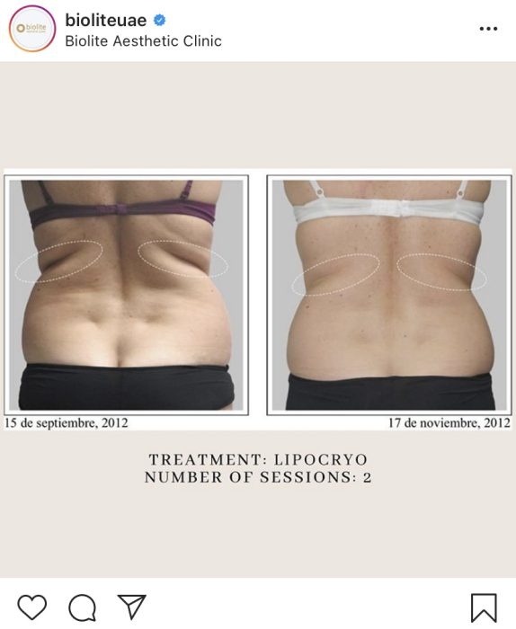 LipoCryo for fat loss