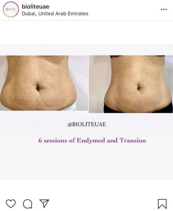 Body Blitz for body contouring