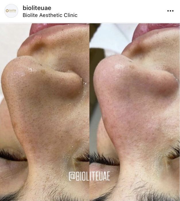 Dermasweep Exfoliation Treatment