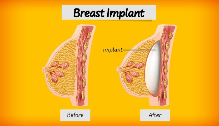 Breast implant