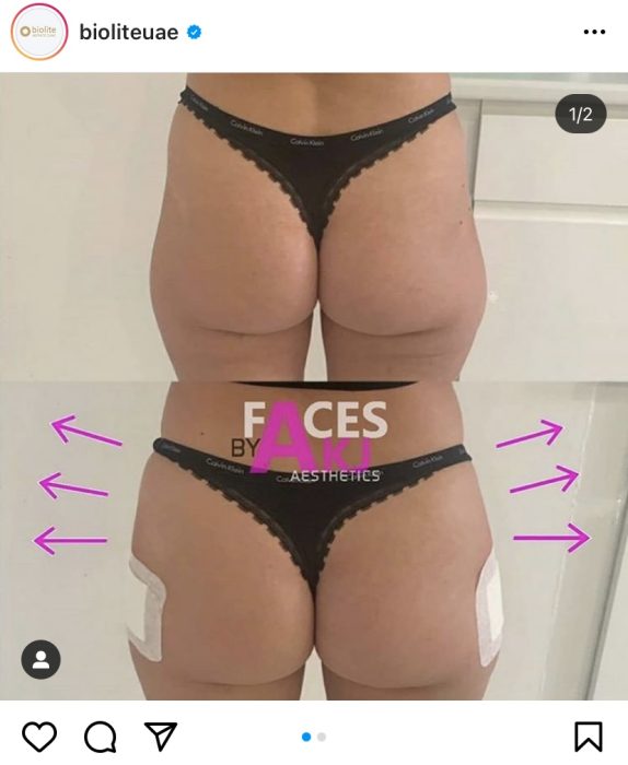 Treatments for lower body