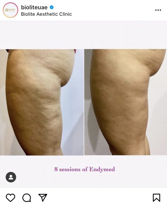 Treatments for lower body