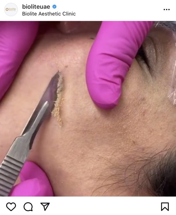 dermaplaning near me