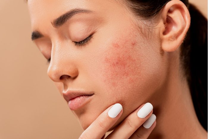 how to reduce hyperpigmentation