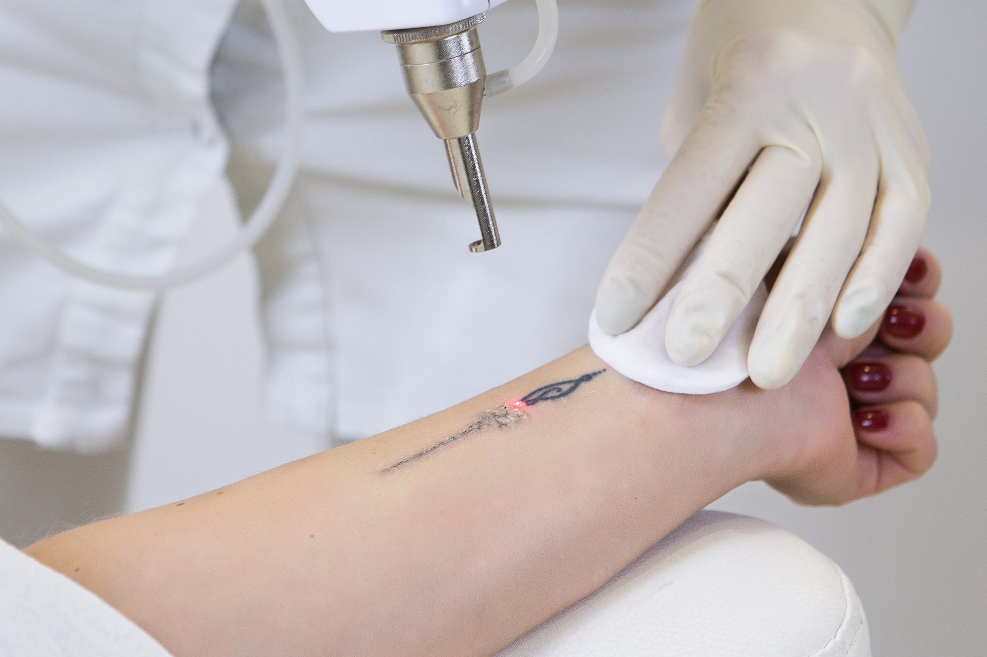 What is the Best Laser Treatment for Tattoo Removal?