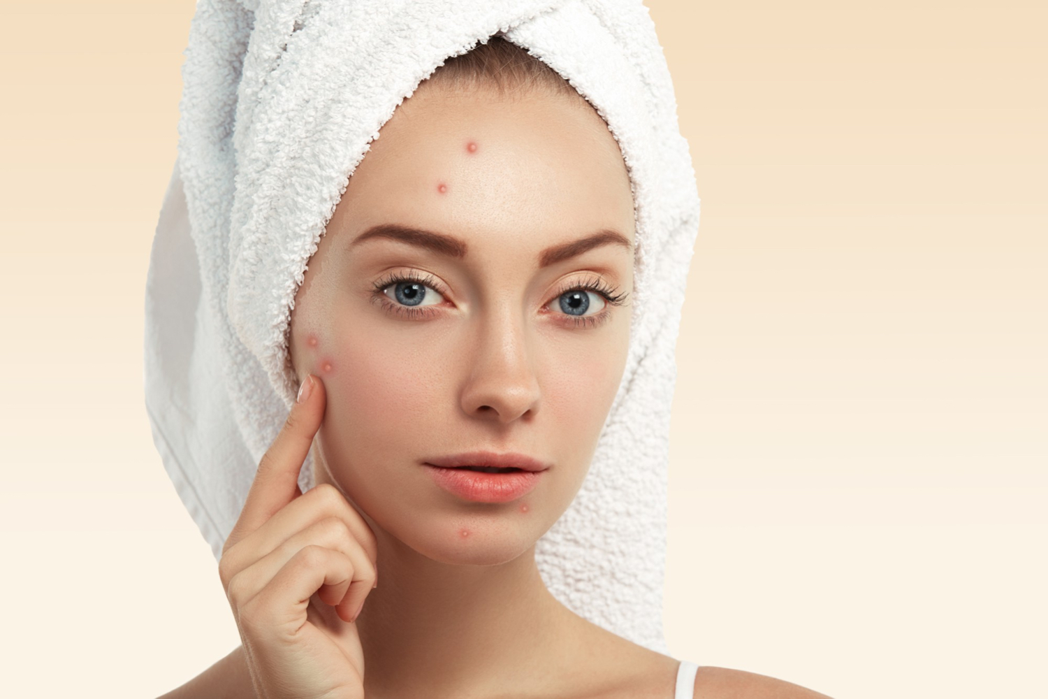 Acne treatments: What’s the right treatment for you?