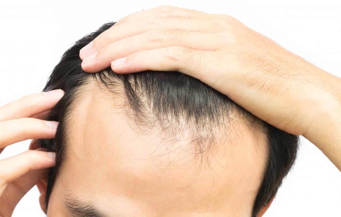 Receding Hairline: Why It Happens and How to Get Rid of It?