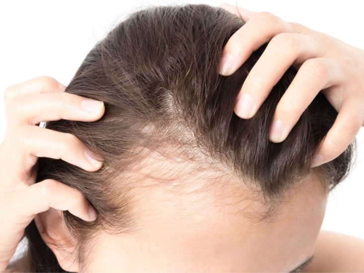 Are You Wondering How To Treat Alopecia Areata?