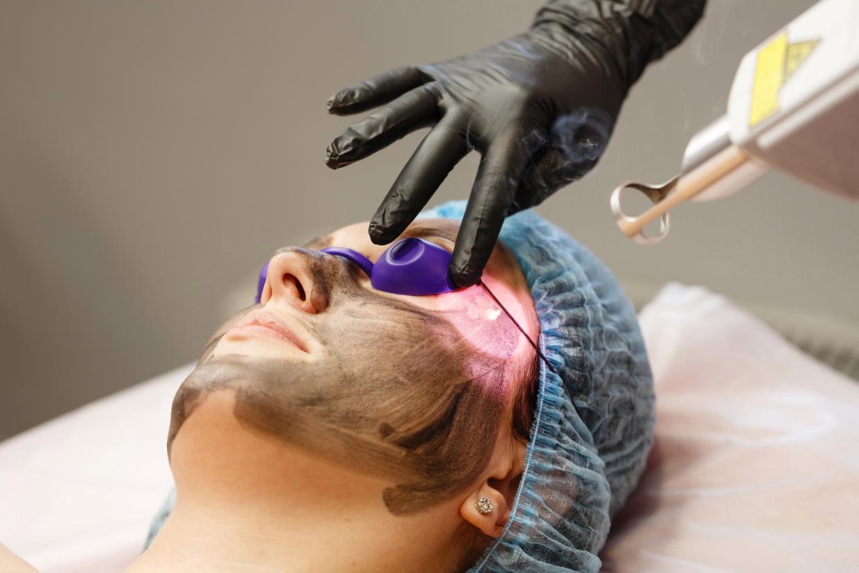 7 Things To Expect While Getting A Carbon Laser Peel