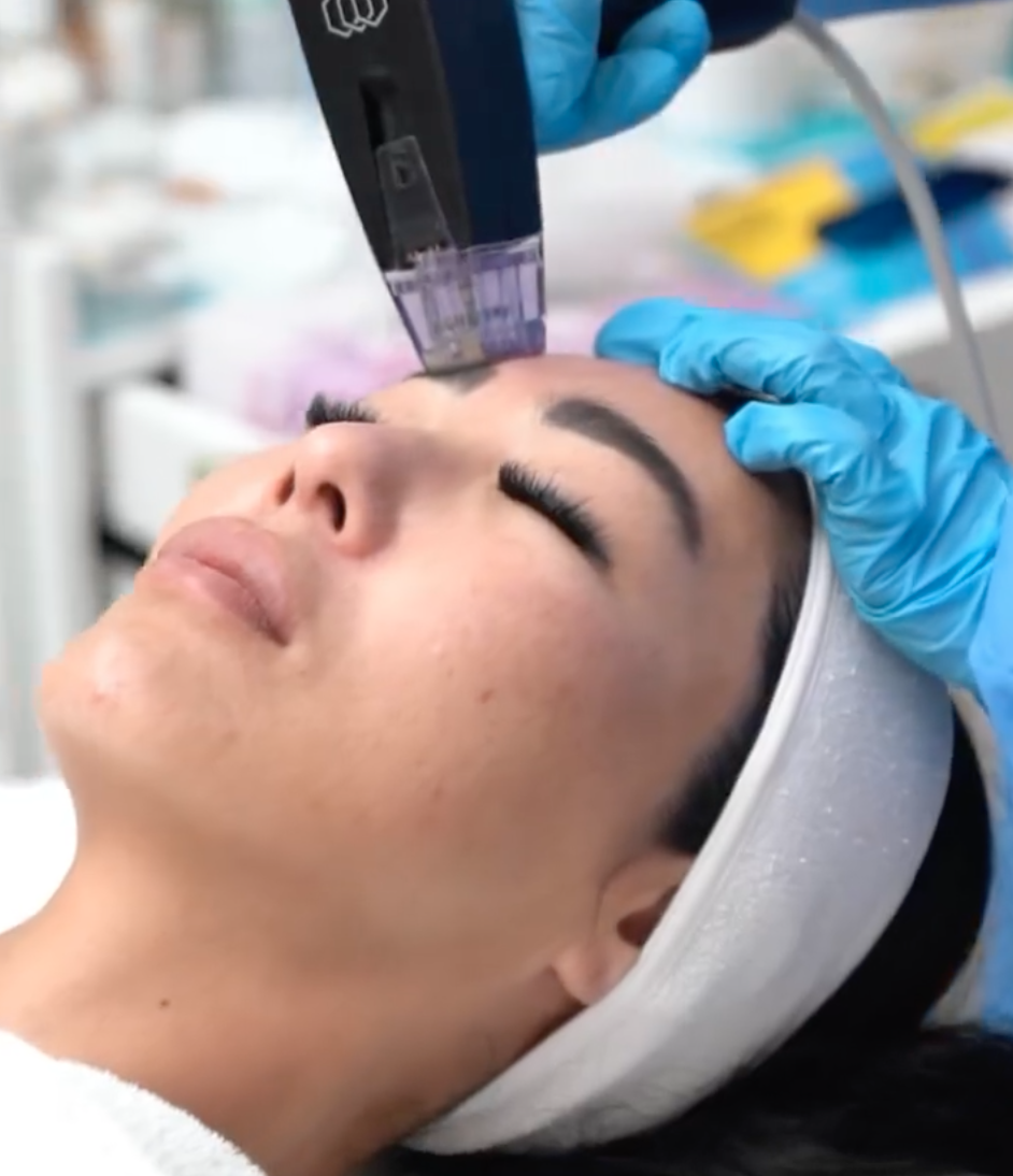 Inmode Morpheus8: The Benefit of Two Technologies in One