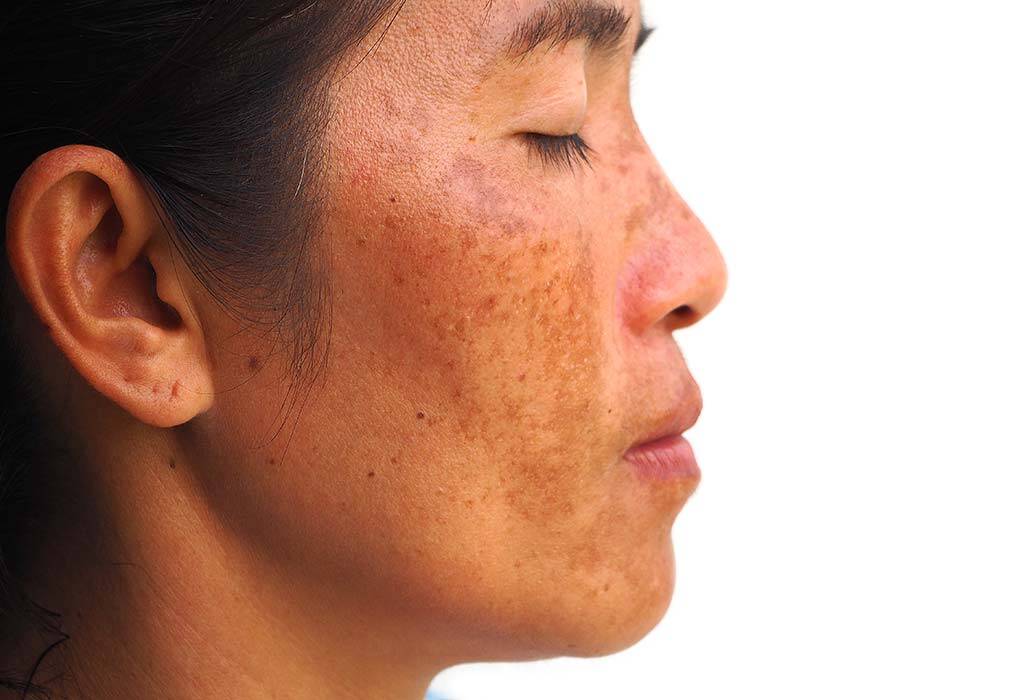 How To Get Rid Of Melasma: 5 Best Melasma Treatments