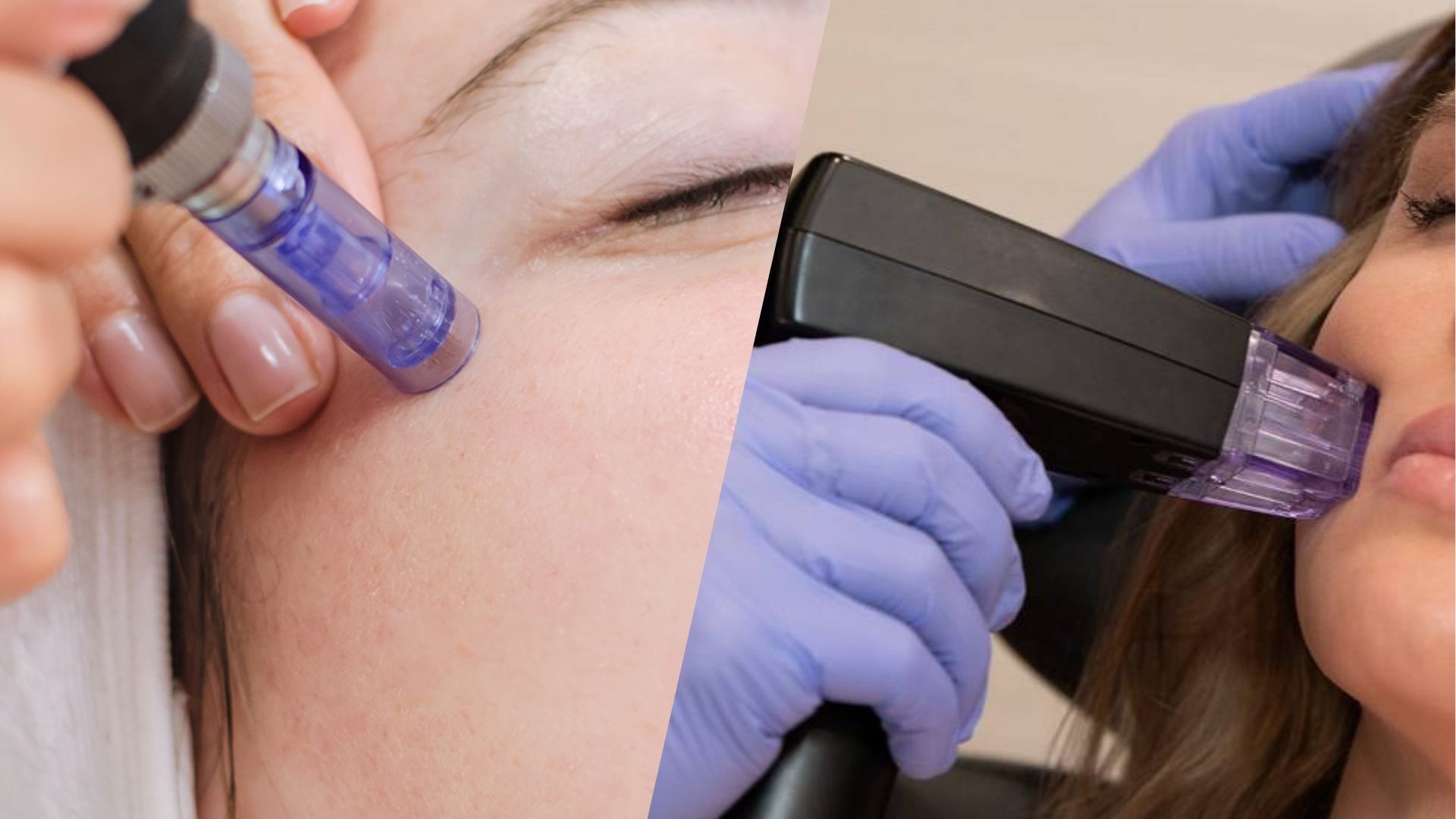 What’s The Difference: Morpheus8 And Microneedling