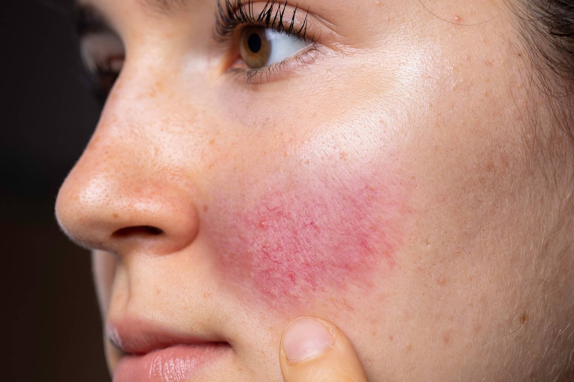 Find The Best Rosacea Treatment Plans Here!
