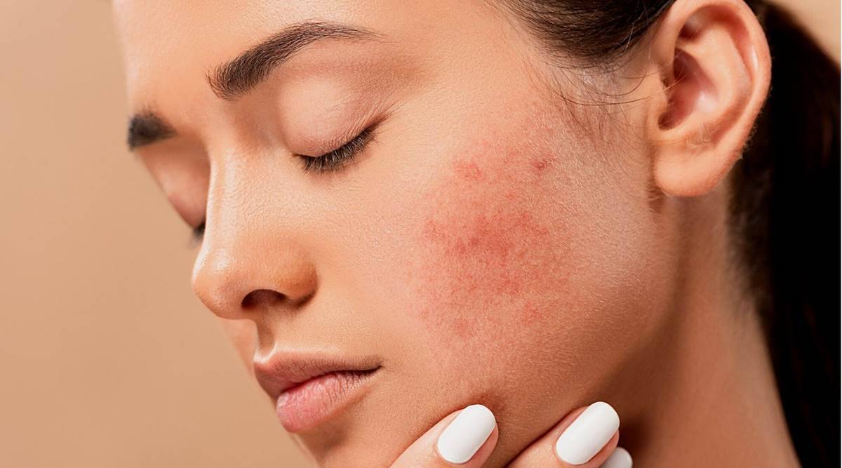Cystic Acne: What Is It, Causes, Symptoms And Treatments